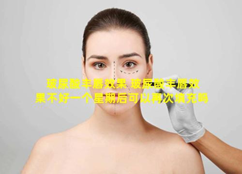 玻尿酸丰唇效果 玻尿酸丰唇效果不好一个星期后可以再次填充吗